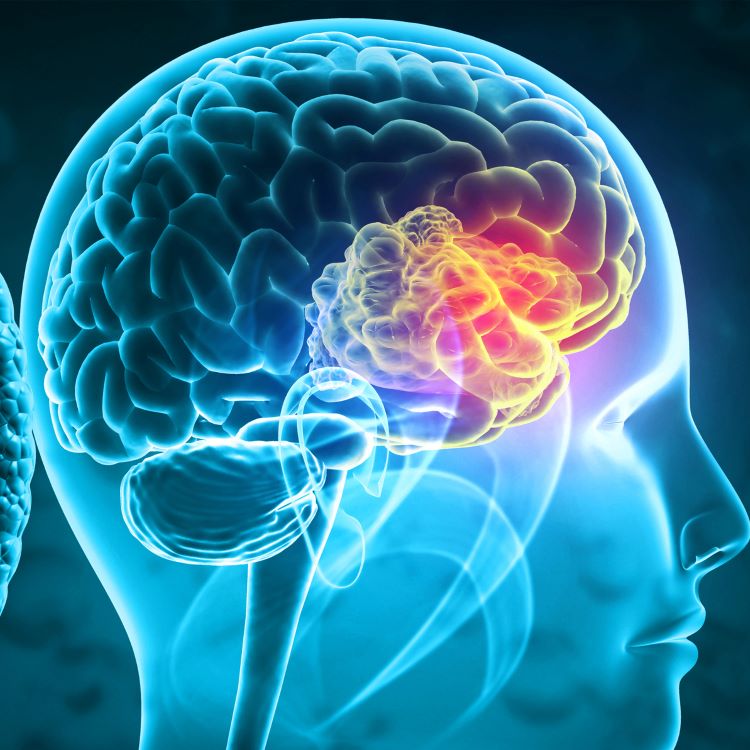 Image of tumour on the brain